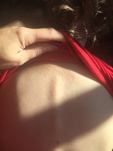 Rash on child's back with shirt lifted up