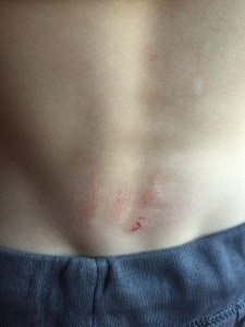 Scratches on child's lower back