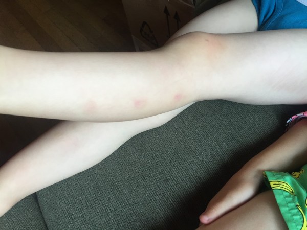 Bug bites healing on preschool child's legs